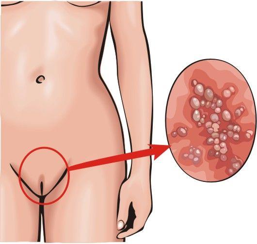 Венерические заболевания у женщин: Как лечить